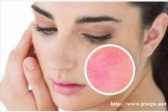 为什么经常出现红血丝激素脸皮炎怎么办 为什么经常出现红血丝激素脸皮炎怎么办