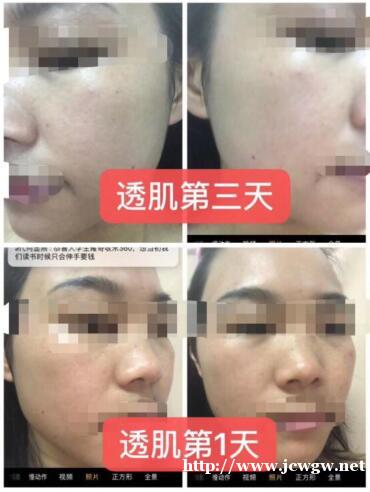 敏感肌肤暗黄斑点可以用七老透肌吗?多少钱? 敏感肌肤暗黄斑点可以用七老透肌吗?多少钱?