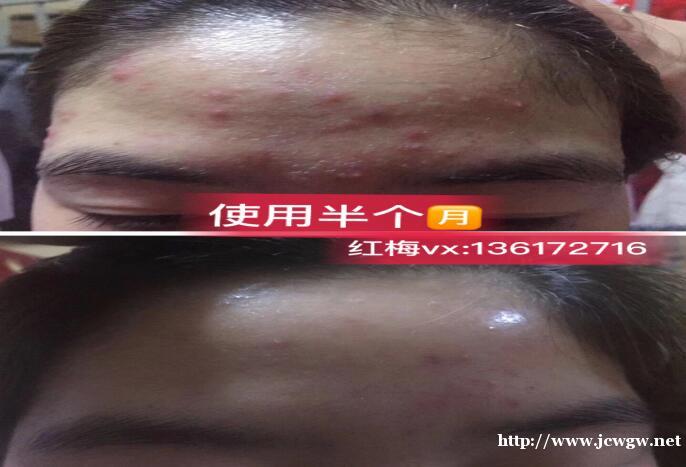 额头的痘痘同一个位置一直都不消什么原因,脸颊的痘痘好多了 额头的痘痘同一个位置一直都不消什么原因,脸颊的痘痘好多了