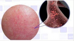 为什么经常出现红血丝激素脸皮炎怎么办