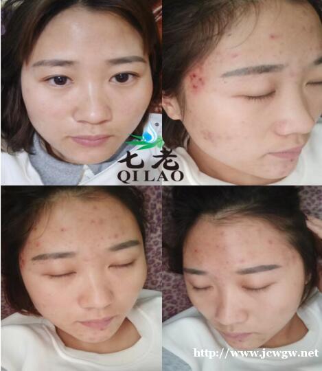 护士长期带口罩长痘用什么牌子更快修复好 护士长期带口罩长痘用什么牌子更快修复好