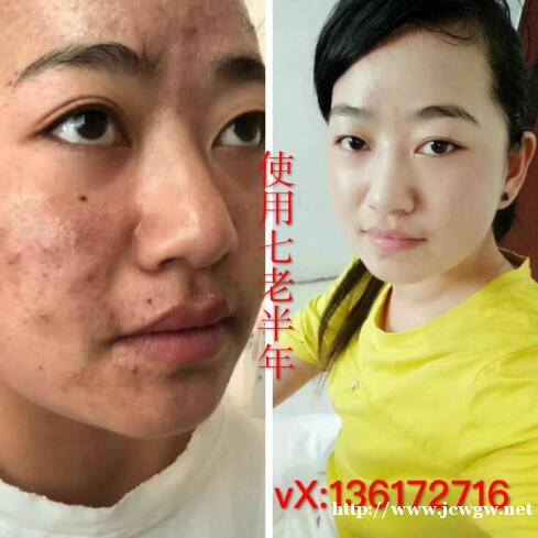 深圳宝安沙井有没有护肤品可以快速修复激素脸? 深圳宝安沙井有没有护肤品可以快速修复激素脸?