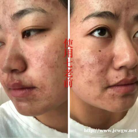 深圳宝安沙井有没有护肤品可以快速修复激素脸? 深圳宝安沙井有没有护肤品可以快速修复激素脸?