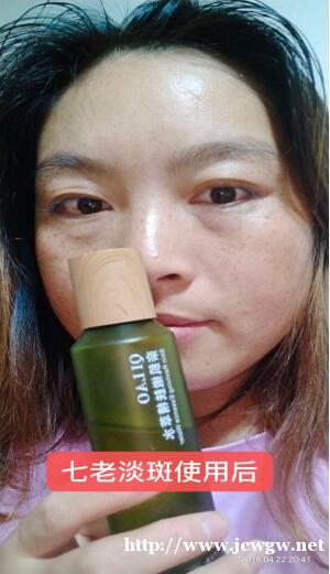 天生雀斑有没有什么安全的产品可以去掉的 天生雀斑有没有什么安全的产品可以去掉的