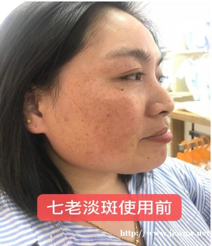 天生雀斑有没有什么安全的产品可以去掉的 天生雀斑有没有什么安全的产品可以去掉的