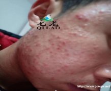 女生长痘怎么办，她还是皮肤科也在用我们七老