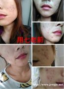 大颗痘痘又硬又痒又肿又痛怎么回事，幸好遇到她