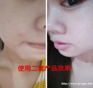 皮肤暗黄有痘痘毛孔粗大用什么护肤品改善