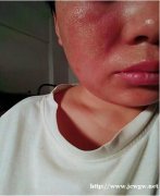 激素脸多久时间可以修复到自愈，修复肌肤屏障受损