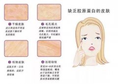 人体缺乏胶原蛋白会有什么症状表现，七老燕窝胶原蛋白