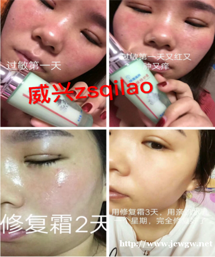 宝宝湿疹怎样快速止痒消除,七老舒缓霜 宝宝湿疹怎样快速止痒消除,七老舒缓霜