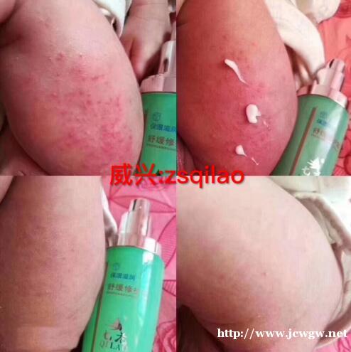 宝宝湿疹怎样快速止痒消除,七老舒缓霜 宝宝湿疹怎样快速止痒消除,七老舒缓霜