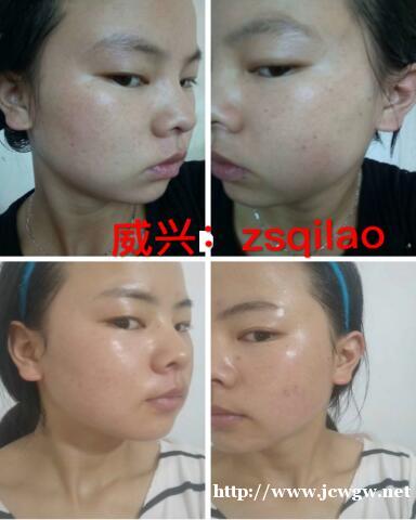 脸上妊娠斑用什么牌子护肤品可以去掉 脸上妊娠斑用什么牌子护肤品可以去掉