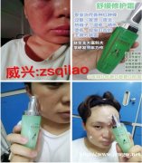 七老舒缓霜,皮肤过敏怎么快速修复红痒肿痛