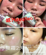 宝宝湿疹怎样快速止痒消除,七老舒缓霜