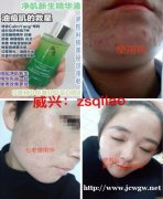 夏天适合痘痘肌肤的护肤品那个牌子好，七老净肌精华液