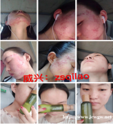 激素脸能治好吗?虽然经历坎坷辛酸,但我痊愈了