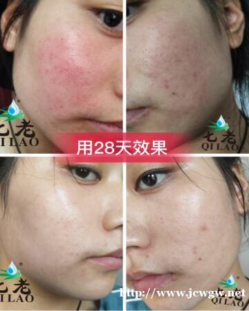 屏障受损要怎么修复,肌肤屏障受损之后皮肤有什么表现 屏障受损要怎么修复,肌肤屏障受损之后皮肤有什么表现