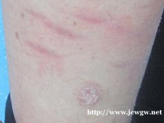 牛皮癣发作症状有哪些呢