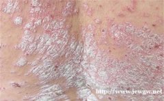 济南银屑病医院诚信惠民，名医荟萃