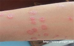 济南银屑病医院用心打造，全国皮肤病最优医院。