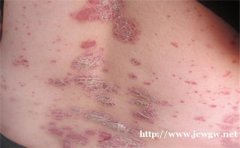 济南银屑病医院坚持以病人为中心，以质量为核心