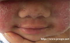 济南银屑病医院以专业呵护皮肤健康，以责任发展医院特色。