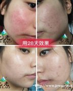 屏障受损要怎么修复,肌肤屏障受损之后皮肤有什么表现