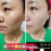 淡斑产品哪个牌子好用,脸上长斑好多年了怎么去除