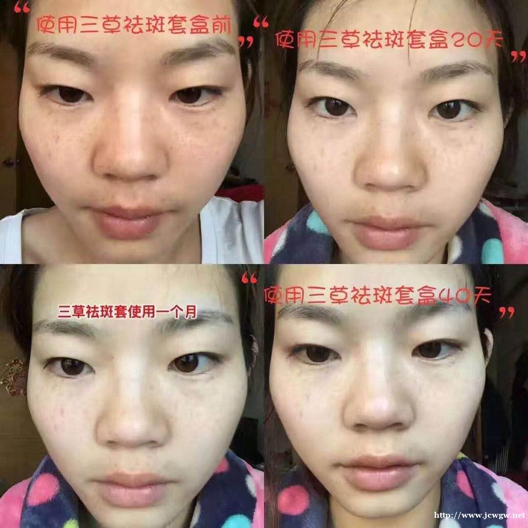 三草两木祛斑产品真的安全有效吗?会反弹吗? 三草两木祛斑产品真的安全有效吗?会反弹吗?