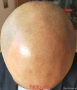 陕西佰鸿再生医学—绽发干细胞外泌体生发