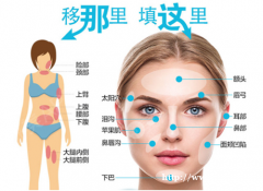 面部脂肪填充的副作用有哪些_成都医美美容