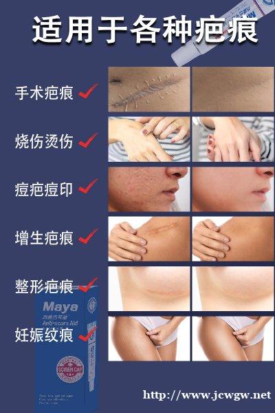 烫伤后的正确处理方式 –玛雅巴可迪 烫伤后的正确处理方式 –玛雅巴可迪