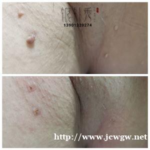 中医火针祛扁平疣丝状疣技术培训 中医火针祛扁平疣丝状疣技术培训