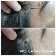 中医火针祛扁平疣丝状疣技术培训